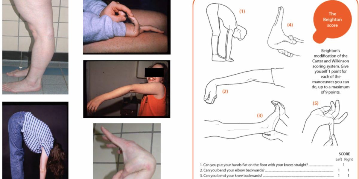Hypermobility and the Beighton Score